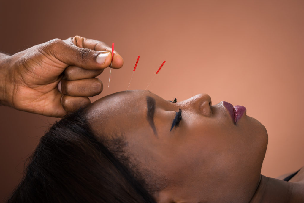 Black woman receives acupuncture